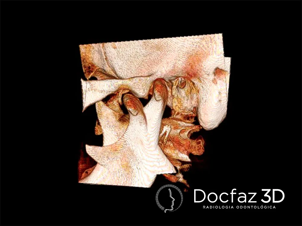 Imagem tomográfica ilustrativa — Disfunção Têmporo-Mandibular