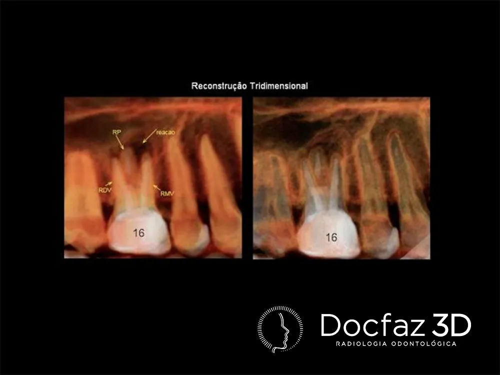 Imagem tomográfica ilustrativa — Endodontia