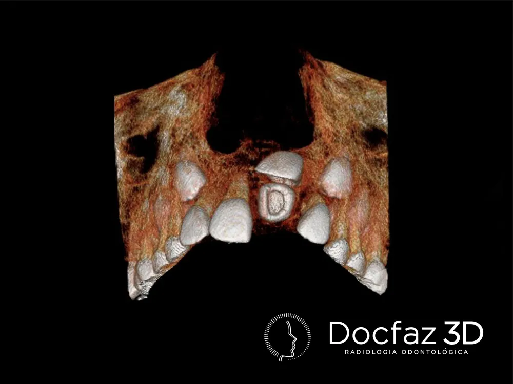 Imagem tomográfica ilustrativa — Odontopediatria