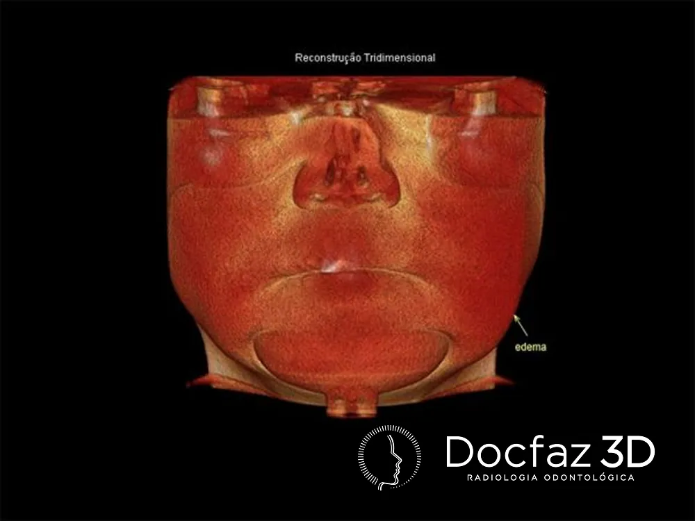 Imagem tomográfica ilustrativa — Patologia Bucal - Esmatologia